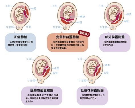 前置胎盤剝離|前置胎盤一點也不可怕！讓醫師教妳平時怎麼做！ 